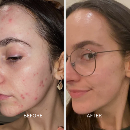 LED Face Mask before and afters
