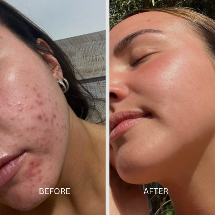 LED Face Mask before and afters