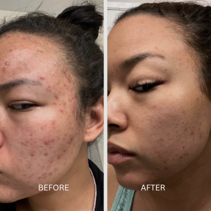 LED Face Mask before and afters