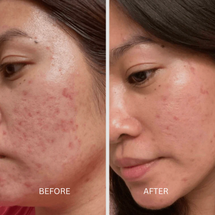 LED Face Mask before and afters